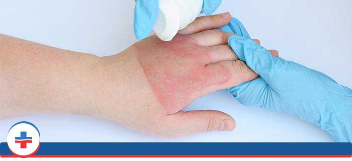 Burns Treatment Near Me in Tibbetts St Portland, Stark Street Portland and Tigard, OR. Burns Treatment Near Me in Tibbetts St Portland, Stark Street Portland and Tigard, OR.