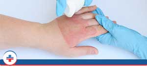 Burns Treatment Near Me in Tibbetts St Portland, Stark Street Portland and Tigard, OR. Burns Treatment Near Me in Tibbetts St Portland, Stark Street Portland and Tigard, OR.