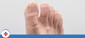 Nail Infection Treatment Specialist Near Me in Portland OR and Tigard OR