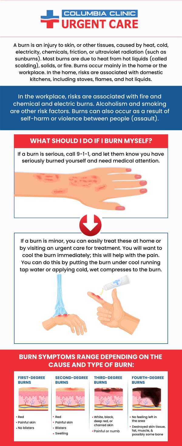 Burns are common injuries that can happen when the skin is exposed to heat, chemicals, electricity, or radiation. Swelling, redness, and skin peeling are all possible burn symptoms. Treatment for a burn can have a variety of benefits, such as pain relief, infection prevention, and a quicker recovery. You can reduce the risk of complications and hasten the healing process by getting care for a burn as soon as possible. At Columbia Urgent Care Clinic, we evaluate burn severity, treat the wound as needed, and prescribe medication to control pain and stop infections. For more information, contact us or schedule an appointment online. We have convenient locations to serve you at Tibbetts St Portland, Stark Street Portland, Portland,  and Tigard, OR.