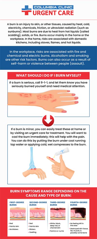 Burns are common injuries that can happen when the skin is exposed to heat, chemicals, electricity, or radiation. Swelling, redness, and skin peeling are all possible burn symptoms. Treatment for a burn can have a variety of benefits, such as pain relief, infection prevention, and a quicker recovery. You can reduce the risk of complications and hasten the healing process by getting care for a burn as soon as possible. At Columbia Urgent Care Clinic, we evaluate burn severity, treat the wound as needed, and prescribe medication to control pain and stop infections. For more information, contact us or schedule an appointment online. We have convenient locations to serve you at Tibbetts St Portland, Stark Street Portland, Portland,  and Tigard, OR.