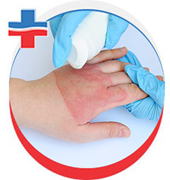 Burns Treatment in Portland, OR