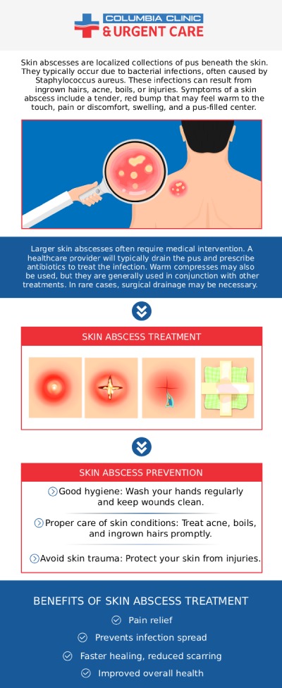 If you are suffering from an abscess, come to Columbia Clinic Urgent Care where our providers will provide comprehensive treatment. For more information, please contact us or request an appointment online. We have convenient locations to serve you at Tibbetts St Portland, Stark Street Portland and Tigard, OR. If you are suffering from an abscess, come to Columbia Clinic Urgent Care where our providers will provide comprehensive treatment. For more information, please contact us or request an appointment online. We have convenient locations to serve you at Tibbetts St Portland, Stark Street Portland and Tigard, OR.