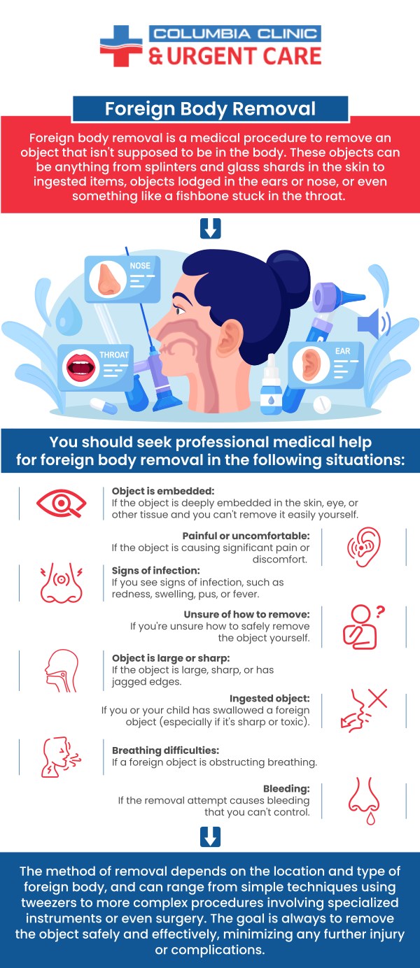 If you have gotten a foreign body in your ear, nose or throat, come to Columbia Clinic Urgent Care where our providers will provide comprehensive treatment. For more information, please call us or request an appointment online. We have convenient locations to serve you in 82nd Avenue Portland OR, Stark Street Portland OR and Tigard OR. If you have gotten a foreign body in your ear, nose or throat, come to Columbia Clinic Urgent Care where our providers will provide comprehensive treatment. For more information, please call us or request an appointment online. We have convenient locations to serve you in 82nd Avenue Portland OR, Stark Street Portland OR and Tigard OR.