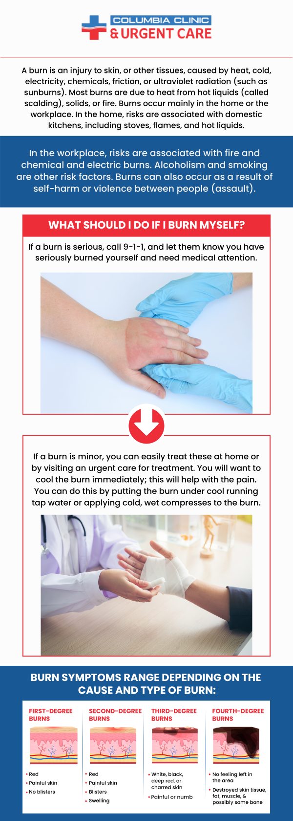If you have sustained a burn injury and require treatment, come to Columbia Clinic Urgent Care. Our professional medical staff is here to help you mend your injury in no time at all. For more information, contact us or book an appointment online. We have convenient locations to serve you at Tibbetts St Portland, Stark Street Portland and Tigard, OR.