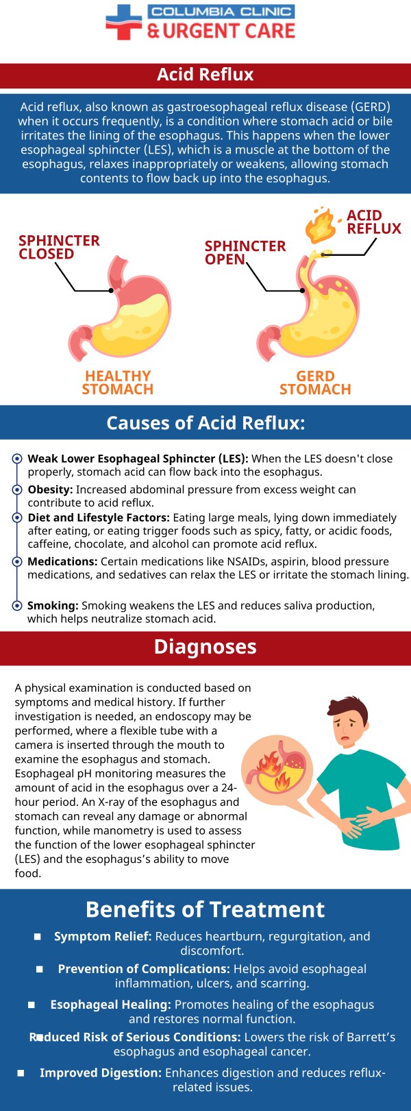 Columbia Clinic Urgent Care & Walk-in Clinic Are Ready to Help You Feel Better!  What is Reflux? Reflux Can Be Referred to by a Number of Different Names Including Gastroesophageal Reflux (GERD), Acid Indigestion, Acid Reflux, and Heartburn. Serving Patients From PDX, Portland OR, Tigard OR, Milwaukie OR, Cedar Hills OR, Cedar Mill OR, Lake Oswego OR, Oak Grove OR, Vancouver WA, Aloha OR, Minnehaha WA, Gladstone OR, Tualatin OR, West Linn OR, Fairview OR, Oregon City OR.