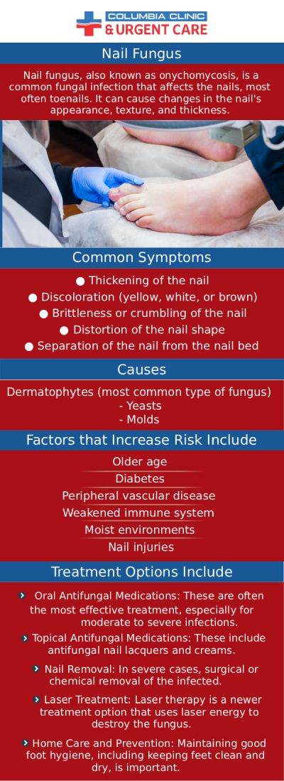 Columbia Clinic Urgent Care helps treat nail infections. If you have a nail infection and need treatment, then call us today or book an appointment online. We have convenient locations to serve you at Tibbetts St Portland, Stark Street Portland and Tigard, OR.